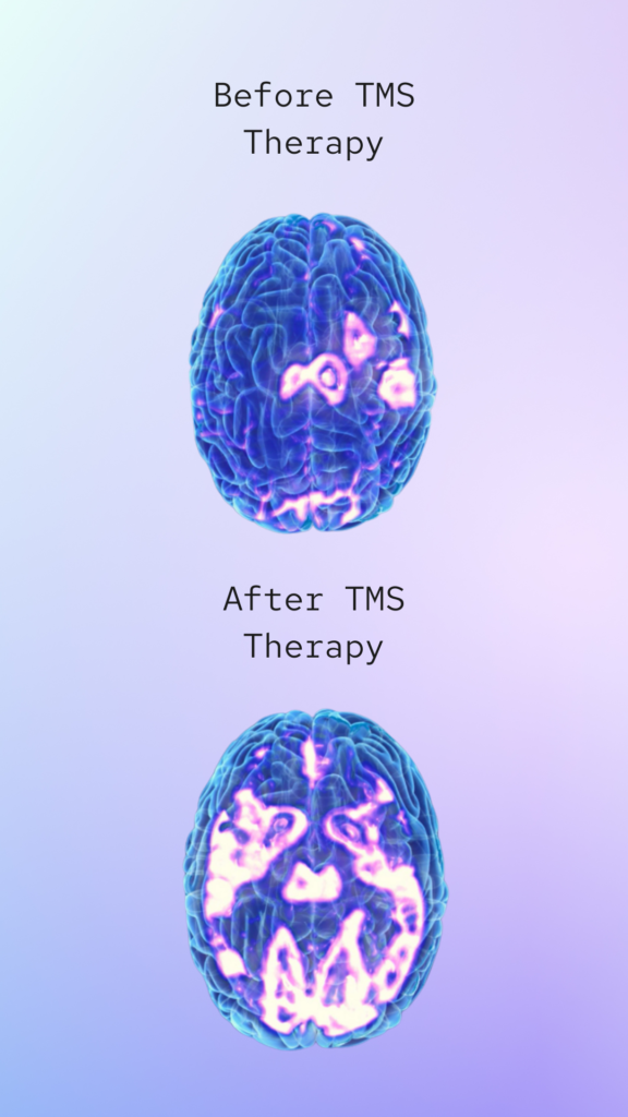 TMS therapy near me